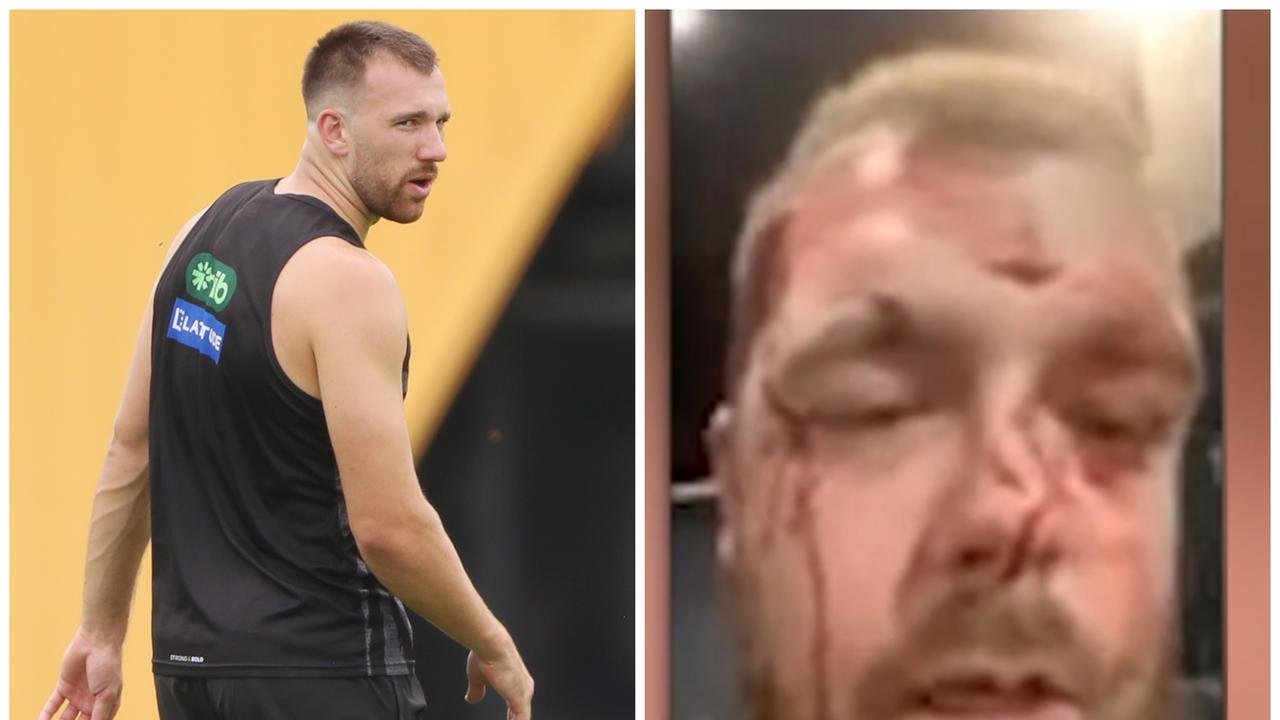 Richmond Tigers Star Waah Balta the victim of Balta and Battered Assault victim