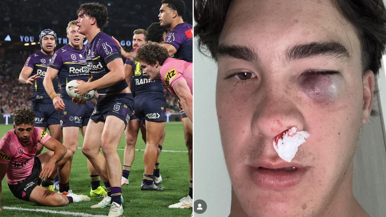Star Star Jack Howarth reveals eye injury